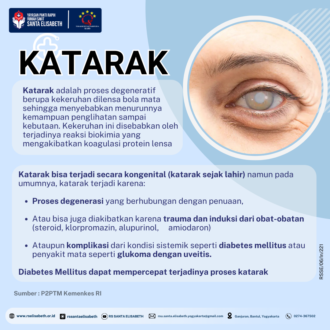 Katarak